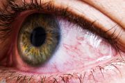 علایم نشان‌ دهنده ابتلا به سرطان چشم
